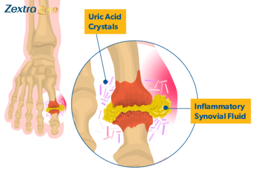 Gout results from urate crystals accumulating in your joint, causing pain and inflammation